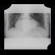 Upside-down stomach, small bowel obstruction, ileus: X-ray - Plain radiograph